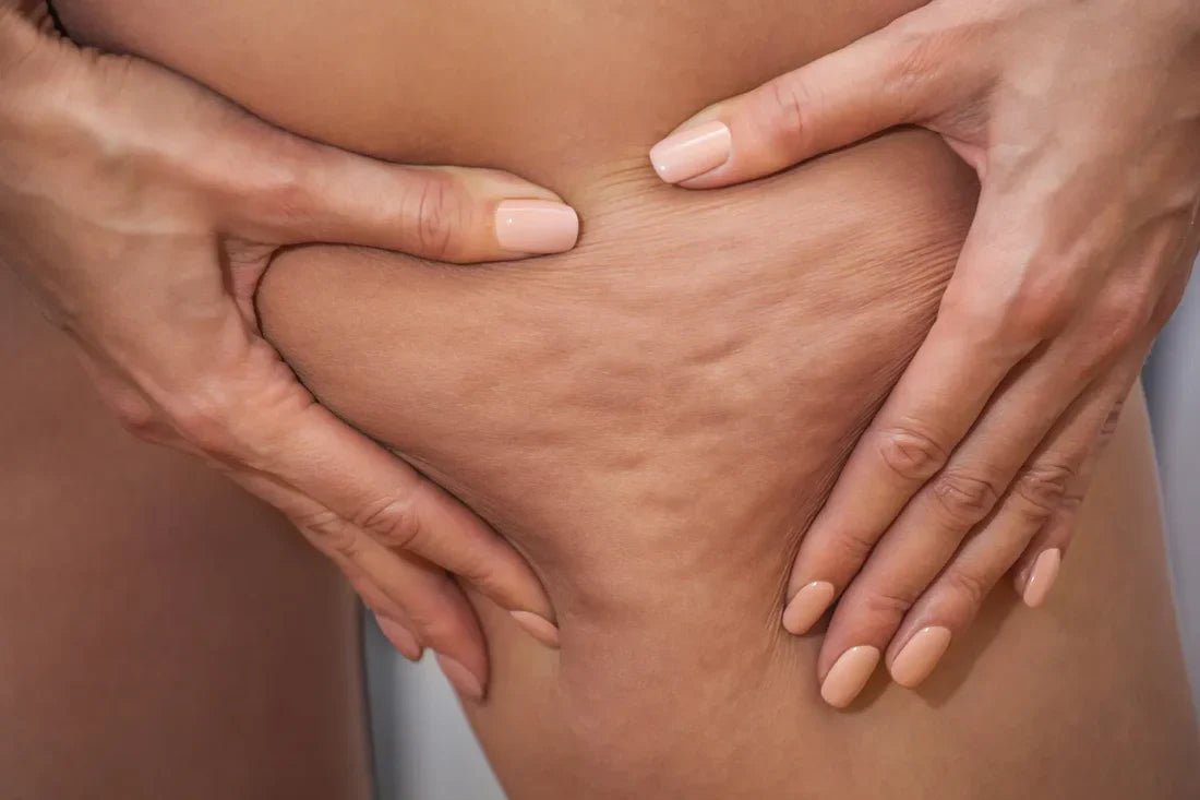 Lipödem mi, Selülit mi, Varis mi? Hangisi Sende Var Biliyor musun? - Tight Tonic