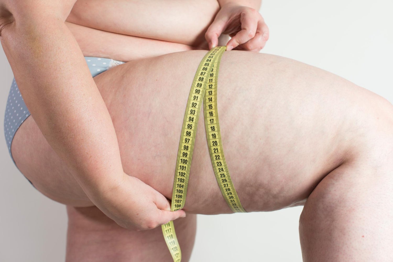 Lipödem Nedir? Görmezden Gelinen Kronik Bir Hastalık - Tight Tonic